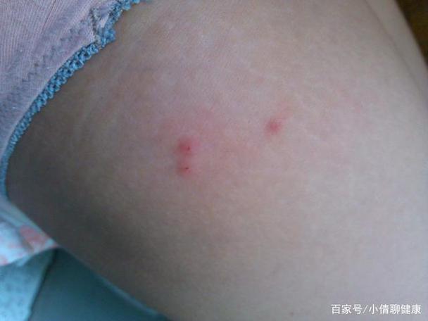 床上螨虫咬的症状图片(床上螨虫咬的症状图片：识别与预防关键指南)