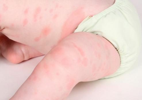 螨虫叮咬后的症状图(螨虫叮咬后的症状图：识别与处理指南)