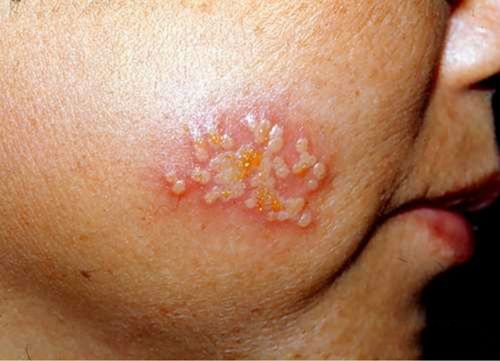 女性艾滋病最明显特征(女性艾滋病最明显特征：关键症状与识别指南)