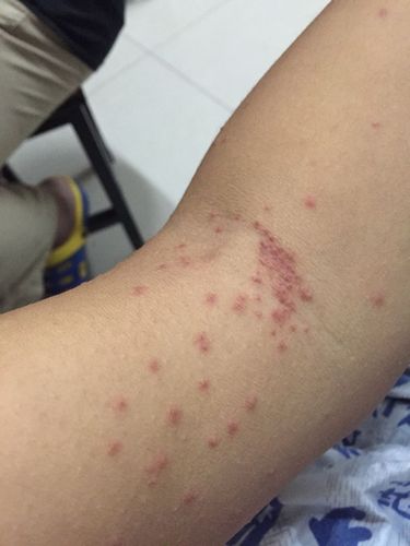 人身上被螨虫咬的图片(“螨虫咬伤图片：揭示人体皮肤上的微小痕迹”)