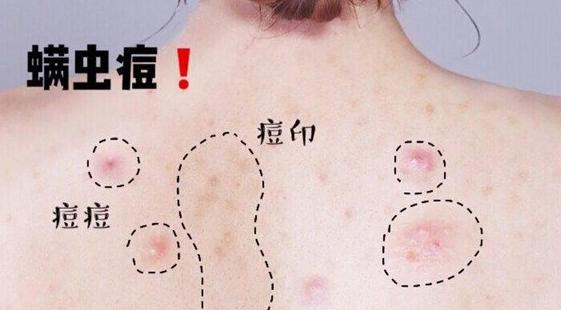 螨虫叮咬后的症状图(螨虫叮咬后的症状图：识别与处理指南)