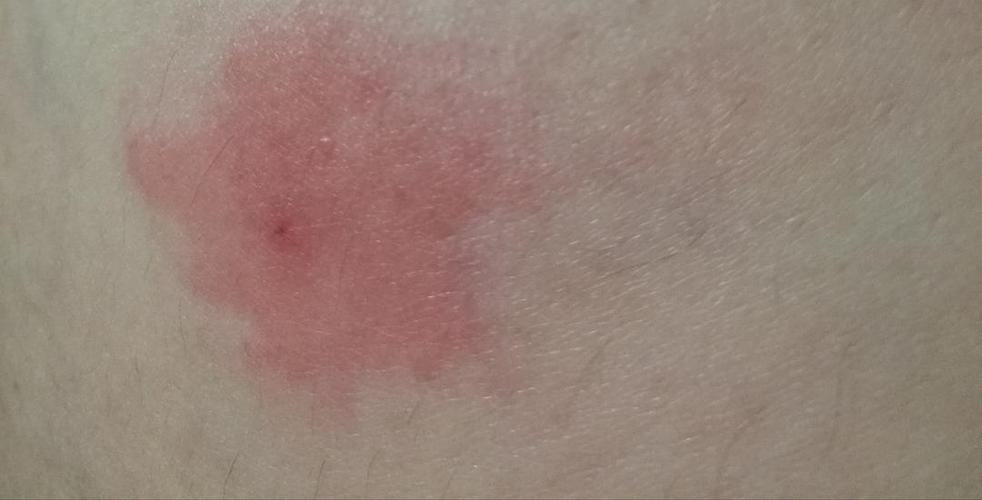 人身上被螨虫咬的图片(“螨虫咬伤图片：揭示人体皮肤上的微小痕迹”)