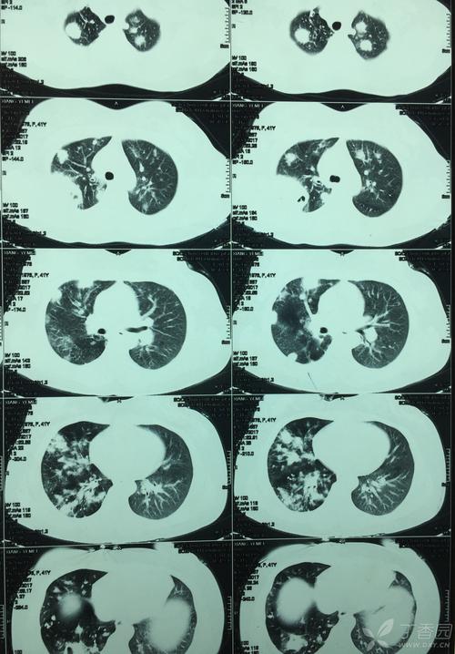 左中肺野外带可疑病灶(左中肺野外带可疑病灶严重吗) 左中肺野外带可疑病灶(左中肺野外带可疑病灶严重吗)