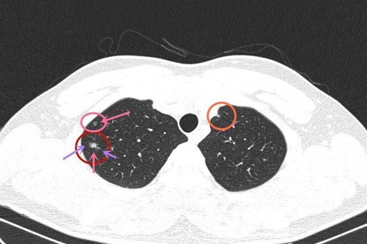 左中肺野外带可疑病灶(左中肺野外带可疑病灶严重吗) 左中肺野外带可疑病灶(左中肺野外带可疑病灶严重吗)