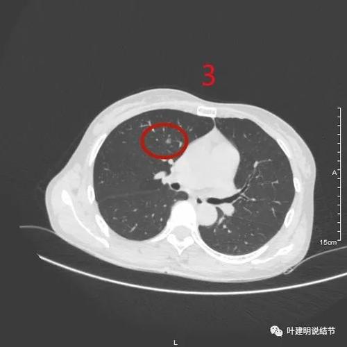 左中肺野外带可疑病灶(左中肺野外带可疑病灶严重吗) 左中肺野外带可疑病灶(左中肺野外带可疑病灶严重吗)